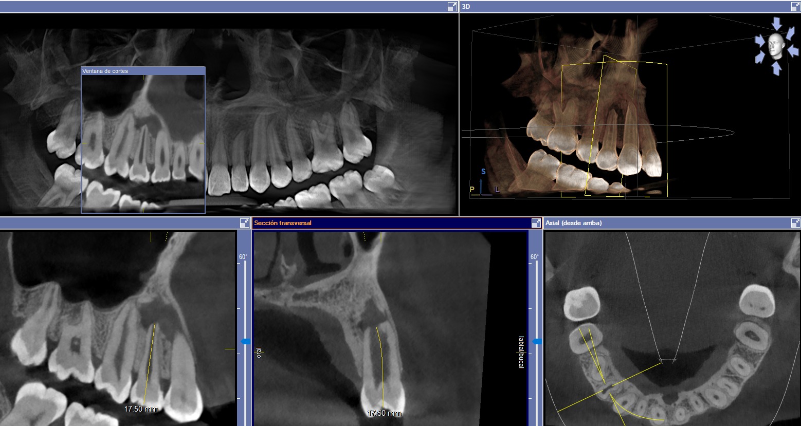 Tomografia 3D - Endodoncia