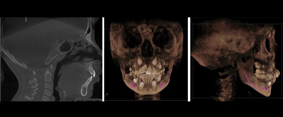 Tomografía 3D - Ortodoncia, Vias Aereas, Cirugia Ortognática
