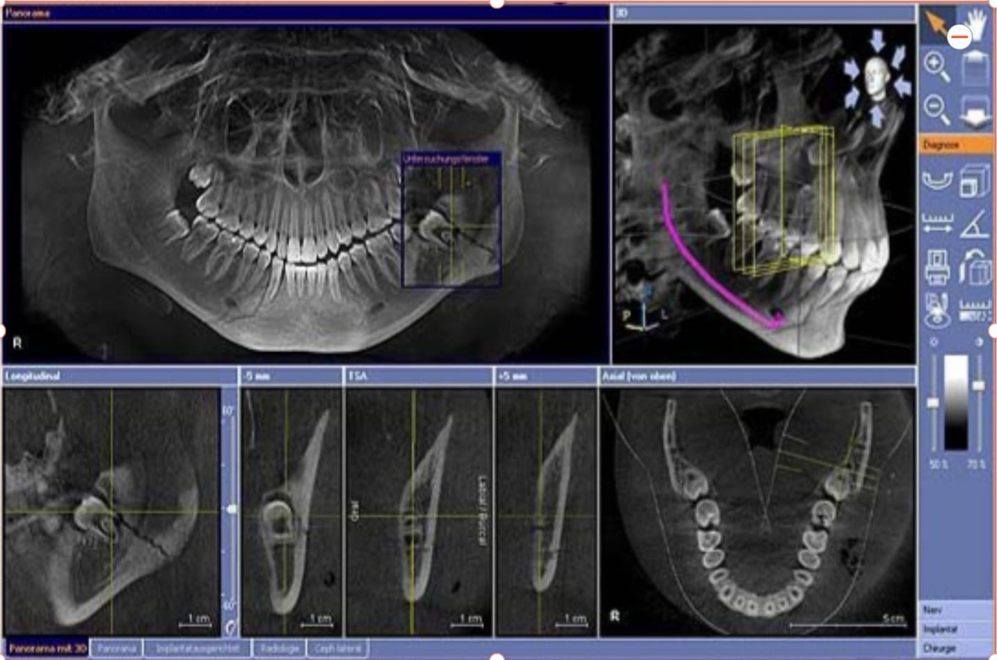 Tomografía 3D Fracturas