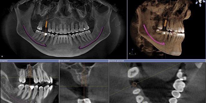 Tomografía 3D para Implante