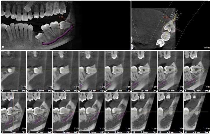 Tomografía 3D 3er Molares
