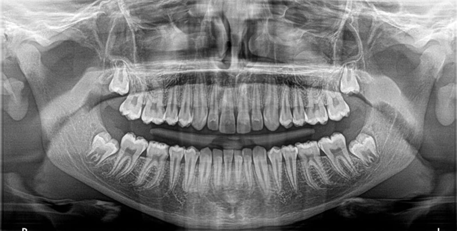Rx. Panorámica Digital