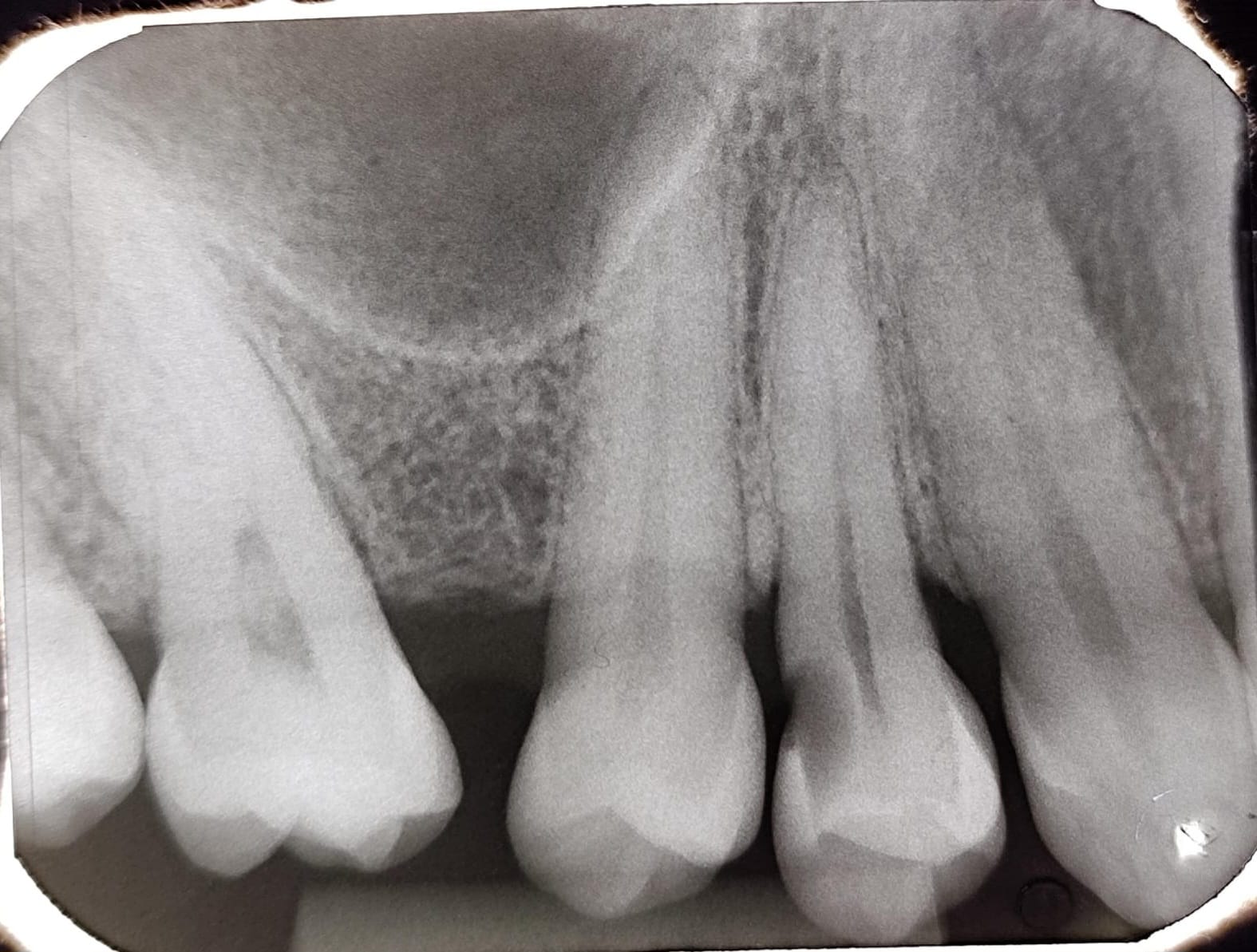Rx. Periapical