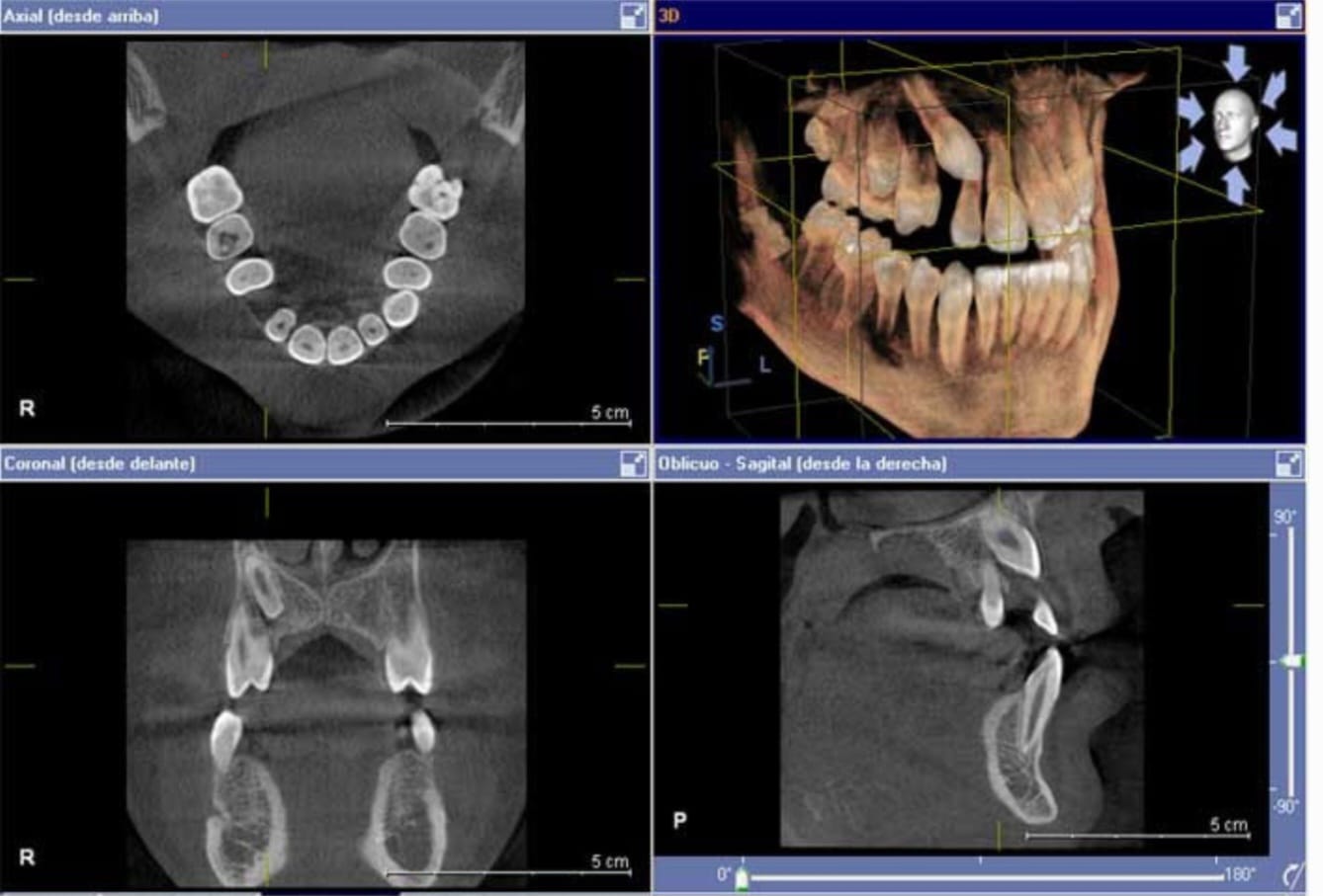 Tomografía 3D Pieza Retenida