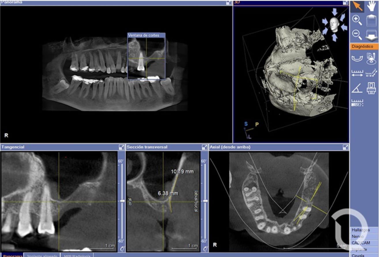 Tomografía 3D Senos Paranasales