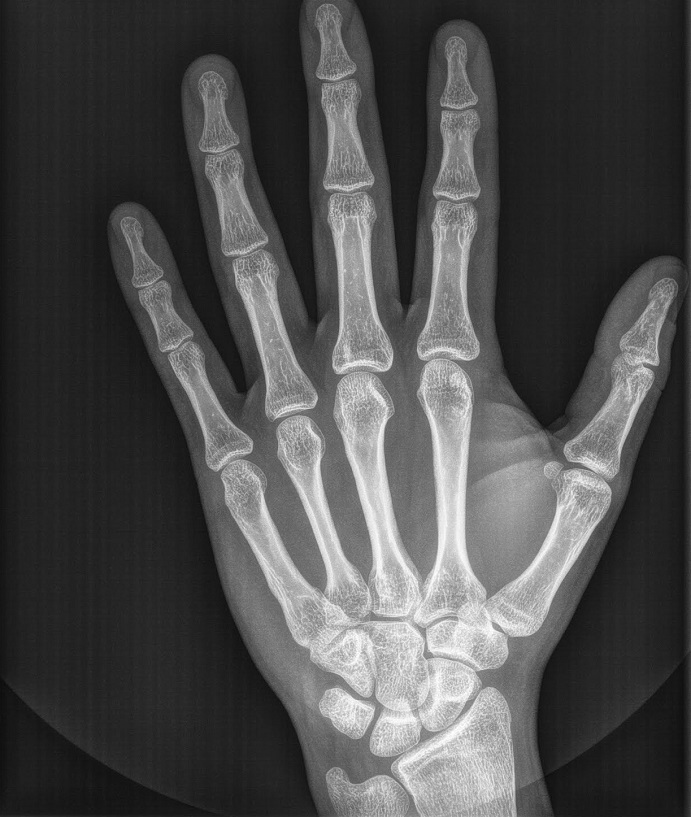 Carpal