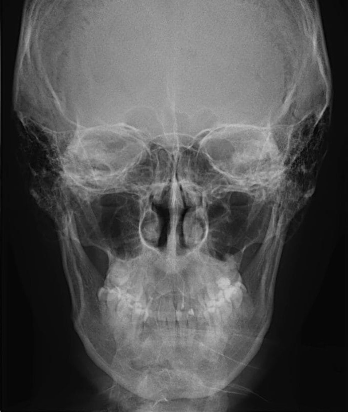 Rx. Frontal / Postero Anterior