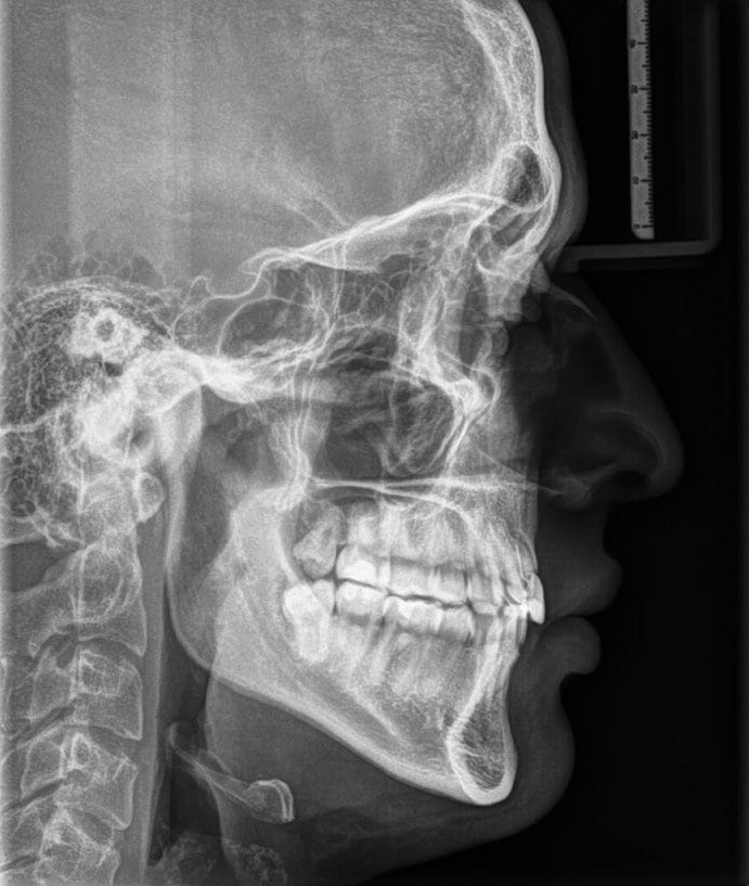 Rx. Lateral / Telerradiografía
